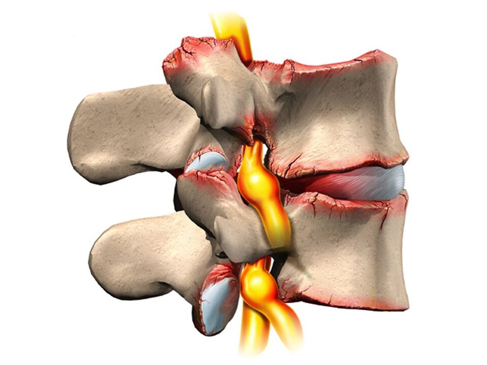 травма позвоночника при остеохондрозе