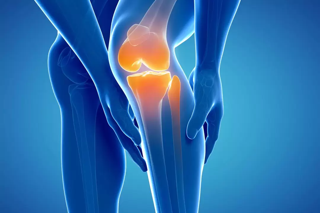 Остеоартроз коленного сустава (гонартроз, деформирующий остеоартроз)